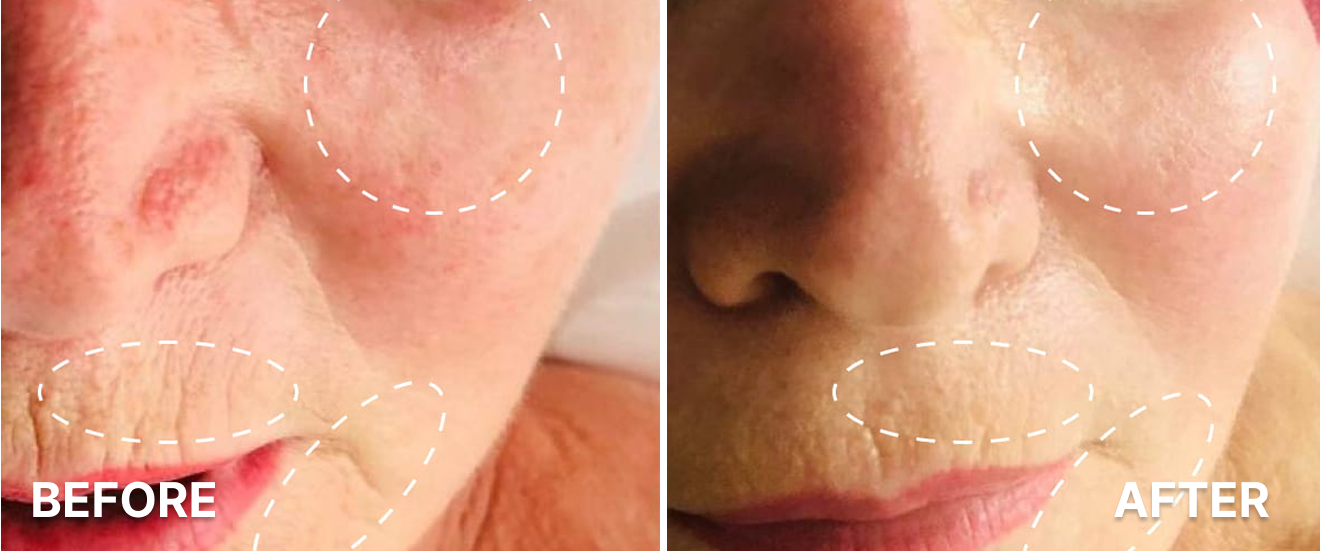 Ageless Microneedling 1
