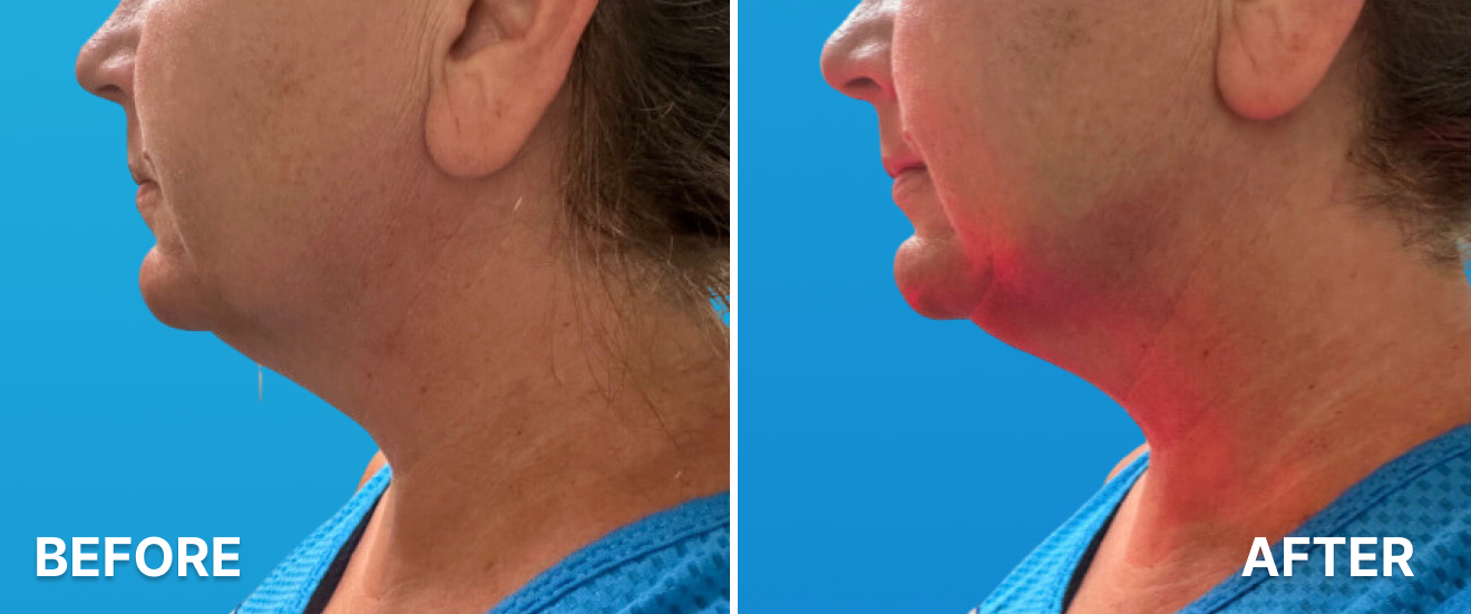 Double Chin Turkey Neck Rescue Treatment 1