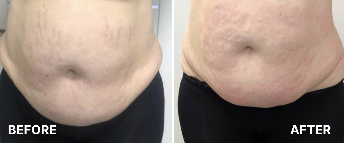 Lipo Laser Cavitation 1