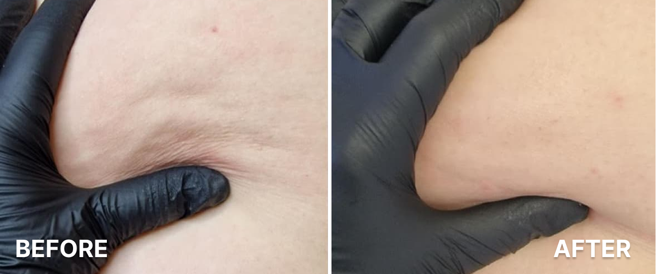 Ultrasound Cavitation RF for Thighs 1